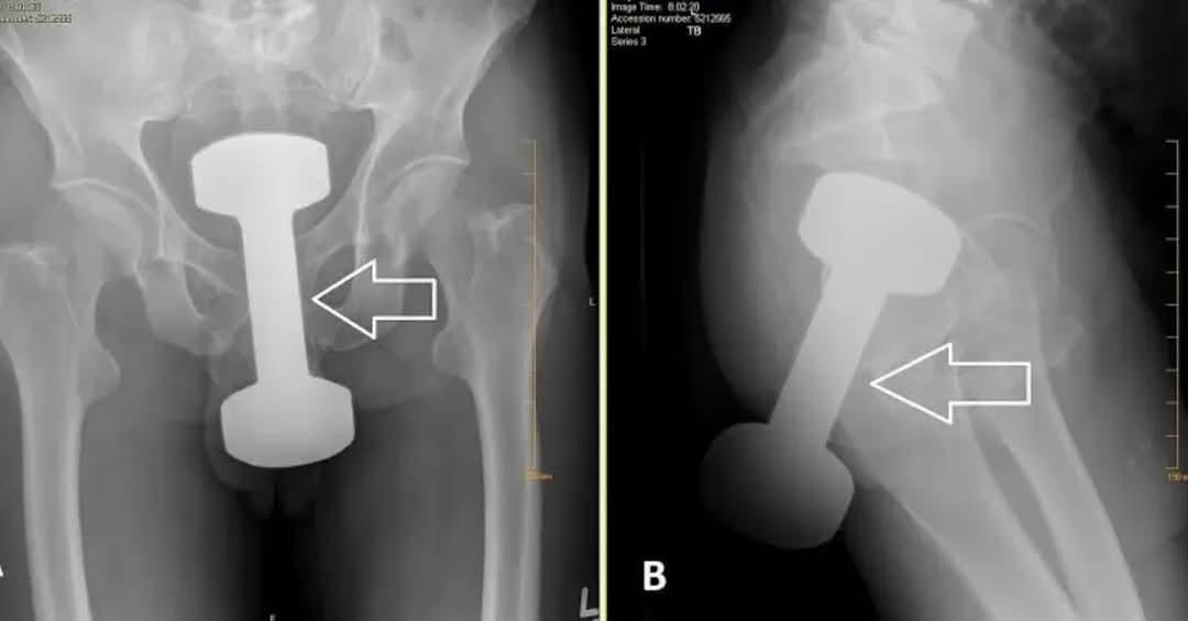 Open hip surgery xray